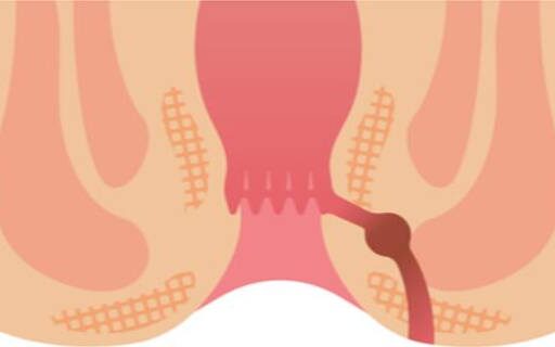 piles treatment in pune